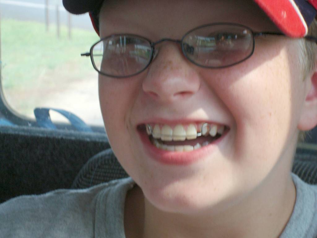 Image of preteen boy wearing glasses and smiling hugely with braces. 